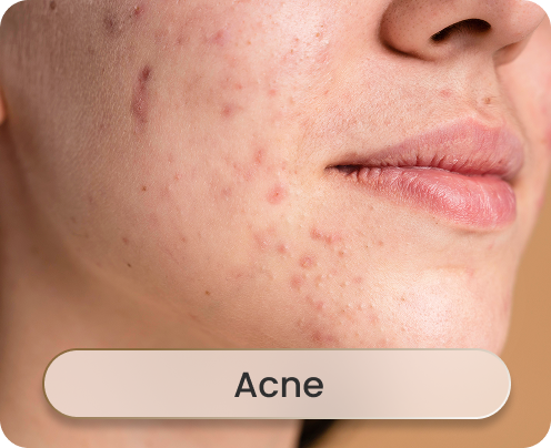 Acne