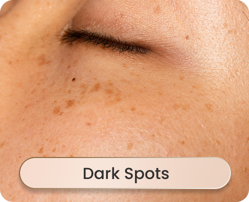 Dark Spots