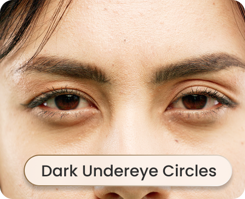 Dark Undereye Circles