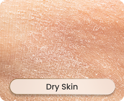 Dry Skin