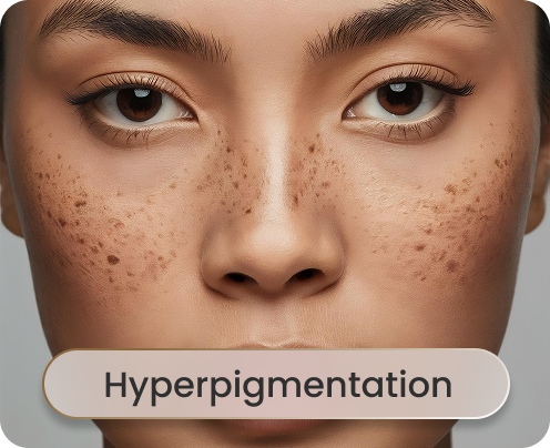 Hyperpigmentation